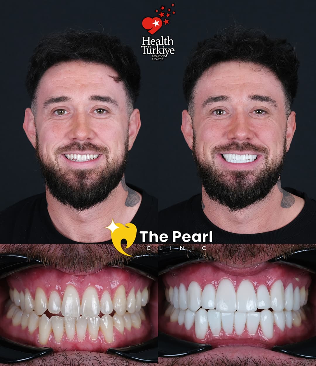 Dental Composite Bonding Smile Transformation